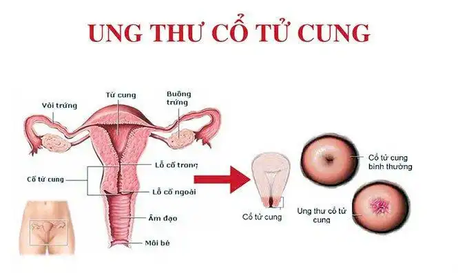 Phòng bệnh ung thư cổ tử cung: Chủ động từ tiêm vắc xin HPV đến sàng lọc định kỳ 1 Ung thư cổ tử cung