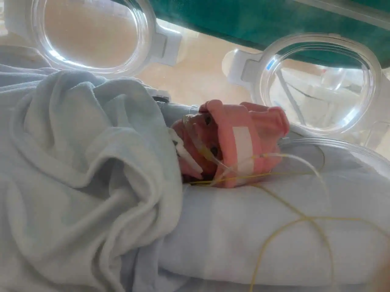 90 ngày đồng hành cùng em bé sinh cực non 25 tuần, nặng 700 gram 1 1790138101506 8547435195863083208 g963198900079824907 e13f40792ceb44d005d1828015a0285b