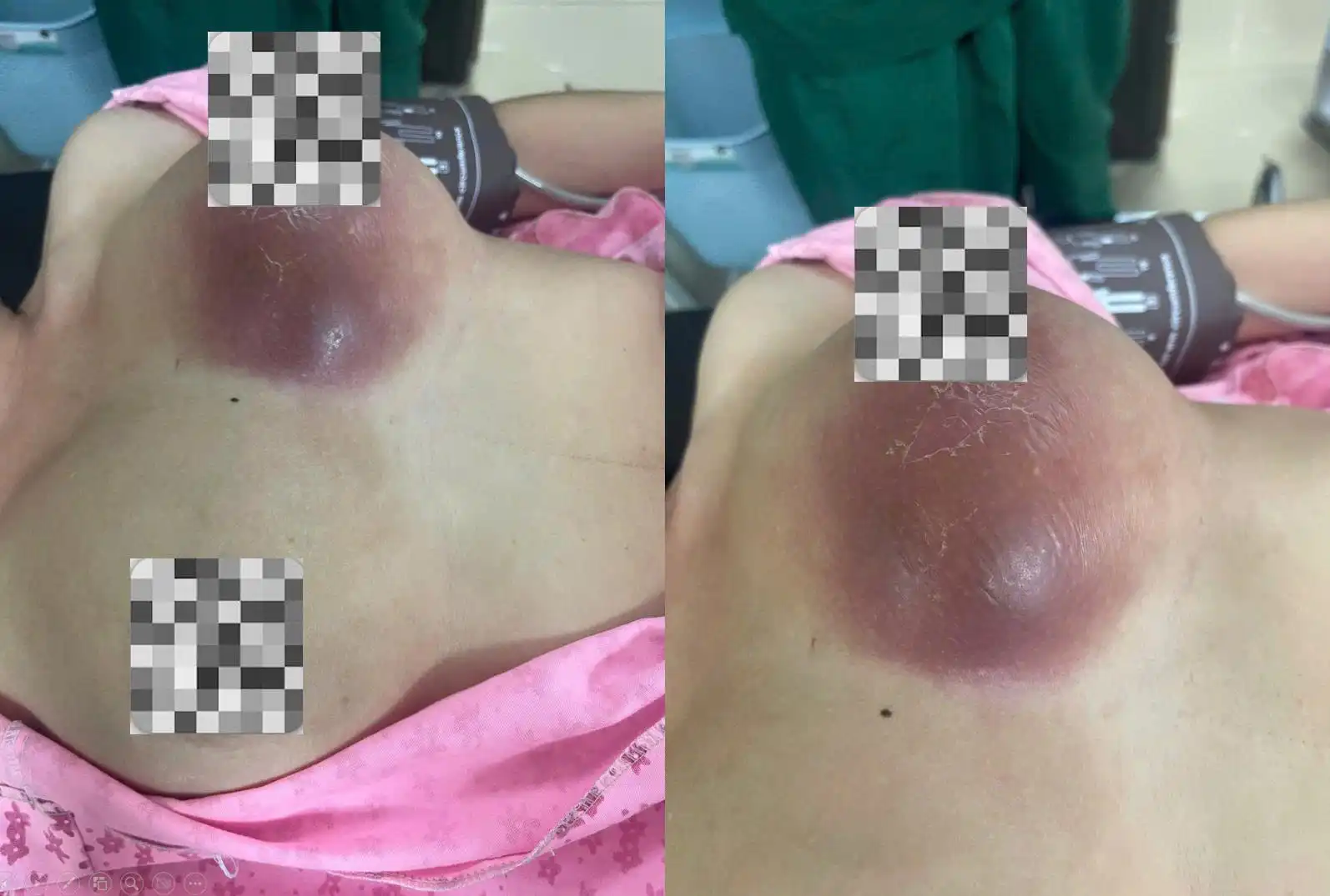 Phẫu thuật áp xe vú sau tắc tia sữa: Cảnh báo từ việc điều trị chưa đúng cách 1 Hình ảnh áp xe vú trái do tắc tia sữa